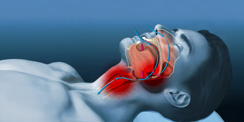 Derila Ergo Pillow helps reduce snoring and improve sleep posture