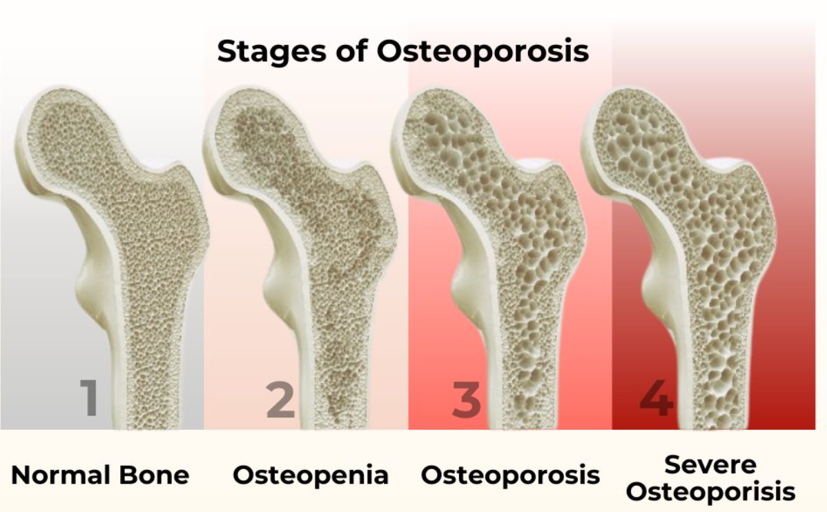 Collagen Protein for Joint and Bone Health